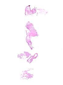 Verslaglegging mutatieanalyse moleculaire interpretatie Sufficient DNA for NGS >20% neoplastic cells Materiaal (FFPE-blokje) ontvangen voor