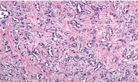 Klassieke pathologie: behandelkeuze op basis van histologie