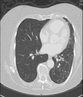 months ago, 47 years, non-smoking Treated with chemotherapy, now developing