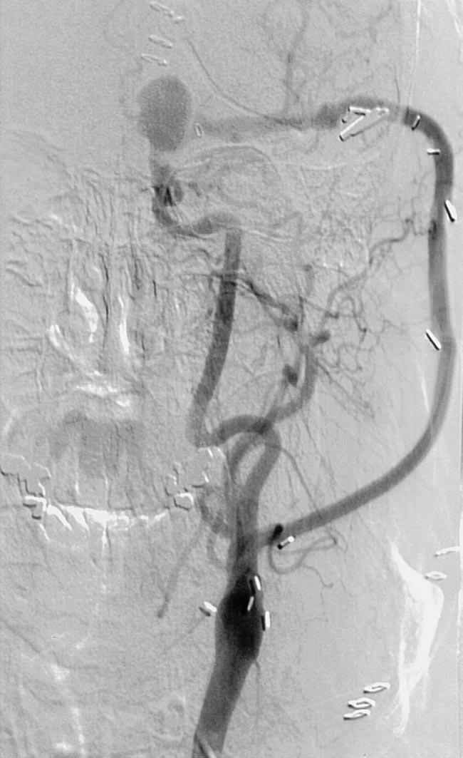 aneurysma trepanatieplaats bypass interna externa communis a b figuur 3. Angiografische beelden van patiënt A in verband met een operatie wegens een aneurysma in de rechter interna.