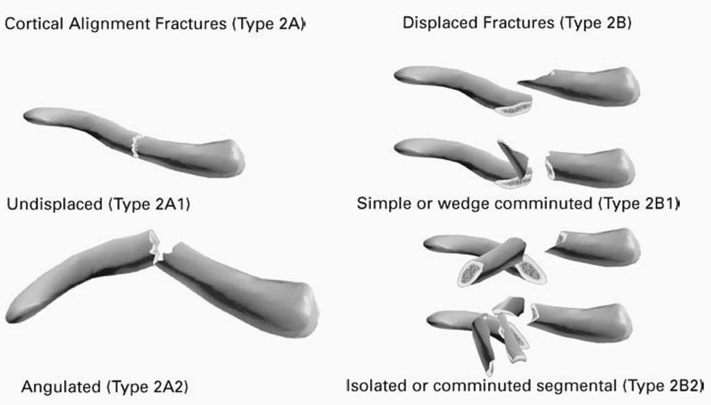 tuur). 6 Ongeveer een kwart betreft laterale fracturen (lateraal van de processus coracoïdeus); deze fracturen vertonen meestal geringe dislocatie.