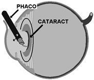 Hierna wordt met een stompe canule (geen prik!) extra verdovingsvloeistof achter het oog geplaatst. De voordelen hiervan zijn dat het oog niet alleen gevoelloos is, maar ook niet meer kan bewegen.