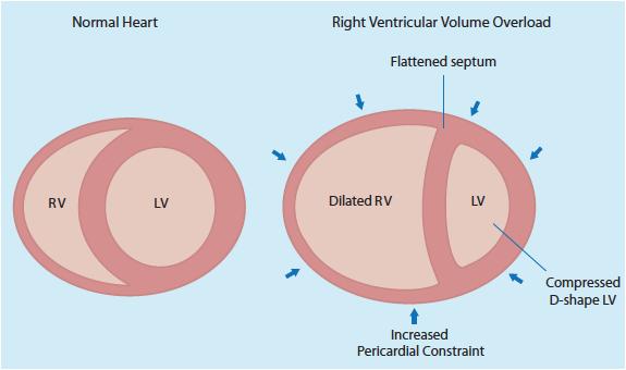 Fysiologie: ventriculaire interdependentie Concept that through direct mechanical interactions the size, shape, and compliance of one ventricle may affect the size, shape, and pressure-volume