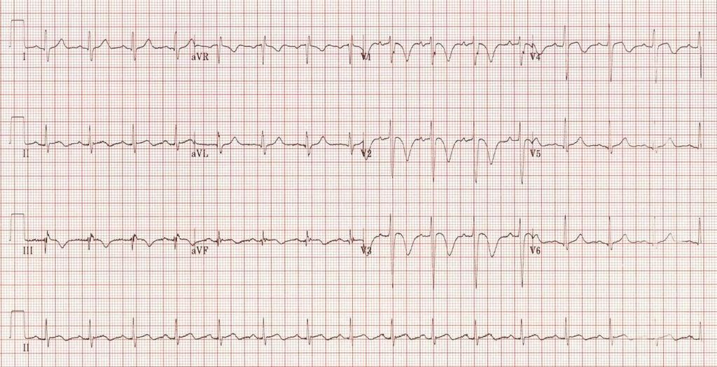 Diagnose RV Falen: klinisch - Hypoxemie - Systemische congestie - ECG: RV strain, S1Q3T3 - Arteriële curve: pulsus paradoxus - Tekens LCOS: hypotensie / tachycardie / oligurie Harjola VP et al.