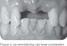 Implantaten en botopbouw bij verlies van één of meer voortanden In het algemeen geldt dat voldoende kaakbot een belangrijke voorwaarde is voor stevig houvast van een implantaat.