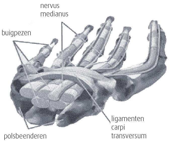 1. Wat is het carpal tunnel syndroom? Dit is een veel voorkomende en hinderlijke aandoening ter hoogte van de hand en de pols veroorzaakt door een geknelde zenuw (nervus medianus).