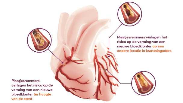 2. Periprocedurele stopzetting DAPT houdt risico s in 5-15% 1 van patiënten ondergaat andere ingrepen dan hartchirurgie tijdens het eerste 2 jaar na plaatsing van een stent In 1 op 5 patiënten die