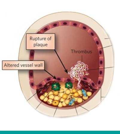 Plaatjesaggregatie versus coagulatie Scheuren plaque Vaatwand plaatjes-rijke trombus Gewijzigde bloeddoorstroming fibrine-rijke trombus Gewijzigde bloedsamenstelling Gewijzigde vaatwand