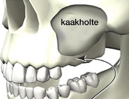 Figuur 2: Links vóór behandeling met weinig kaakhoogte en een grote kaakholte (sinus). Rechts een verhoogde bodem van de kaakholte met (kunst)bot. In dit geval zijn drie implantaten direct geplaatst.