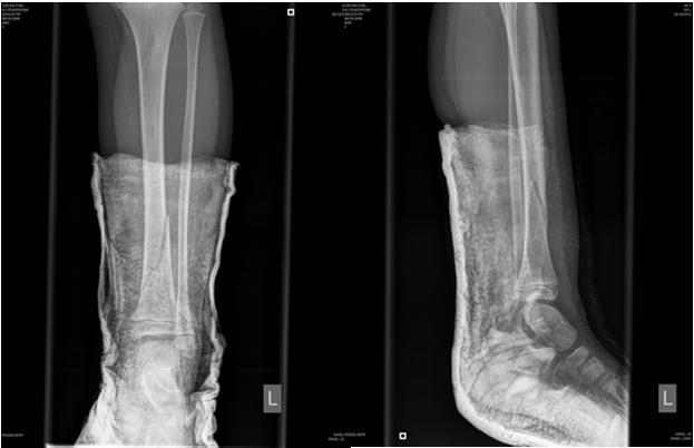 ONDERZOEK UW PATIËNT Open vs Gesloten fractuur Neurovasculair Stand, cave ROTATIE En vermeld al deze gegevens op de wachtnota, MEDICOLEGAAL ZEER