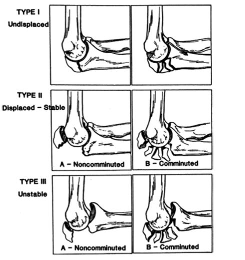 Figuur 18: The Mayo Classification voor olecranonfracturen. (41) 2.4.4 Complexe fracturen Bij een trauma van de elleboog ontstaan er vaak meerdere breuken.