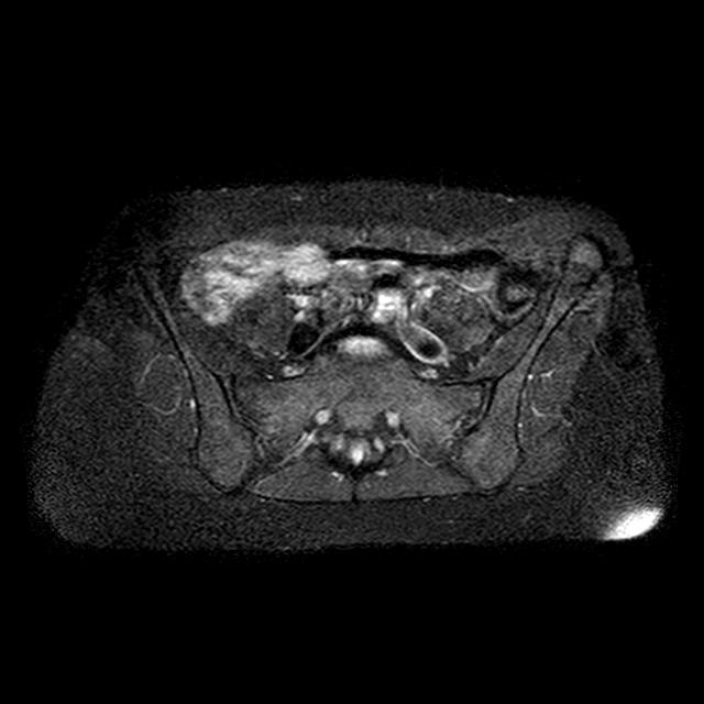 Termen gebruikt in de kliniek: ability Pelvic inst Los of g eblokke erd Instabiele discu s Verschoven wervel SI gewri cht