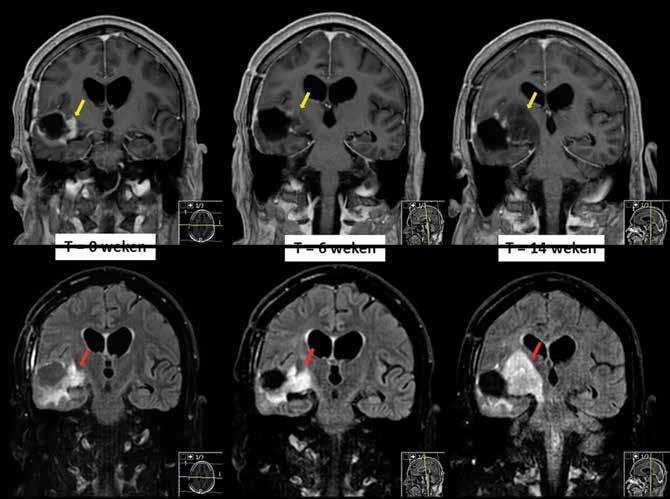 T = 0 weken T = 6 weken T = 14 weken Figuur 2. Illustratie van pseudorespons op coronale MRI-beelden gedurende behandeling van het hooggradig glioom met bevacizumab.