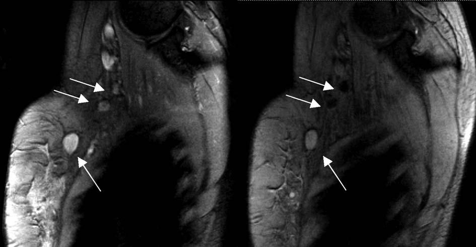 A B Figuur 3. MRI van lymfeklieren toont een saggitaal gereconstrueerd beeld van de axilla met enkele lymfeklieren (pijlen). In vergelijking met A. is in B.