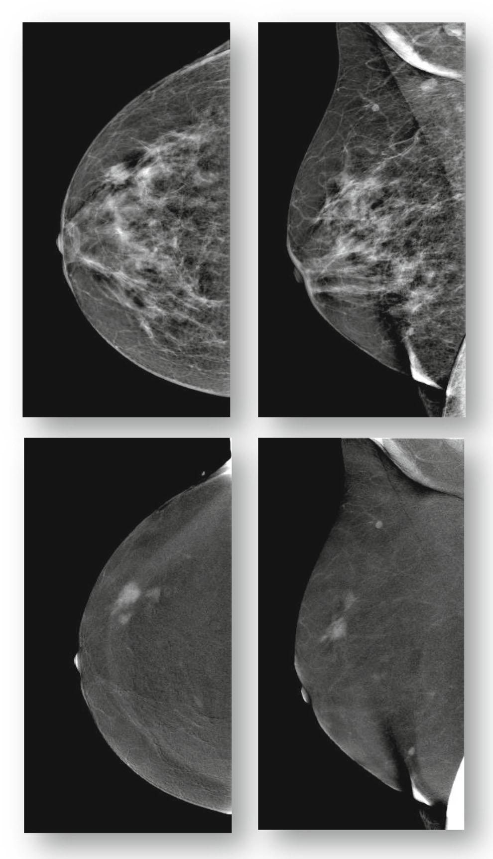 CESM Table 2 Overview of the diagnostic performance of mammography versus contrast-enhanced spectral mammography (CESM) Mammography CESM Sensitivity (%) 96.9 (83.7 99.5) 100.0 (89.0 100.