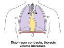 bronchitis - Emfyseem Astma inflammatoire longziekten - Variabele obstructie - Reversibiliteit Indicatie van spirometrie 1 Om klachten te bevestigen of te