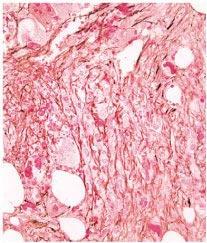 000 Primaire myelofibrose Botvorming, collageen fibers in BM 1:100.