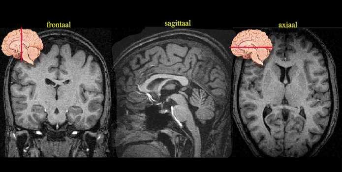 ingestuurd en kaatsen gedeeltelijk terug MRI: Een sterk