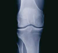 Röntgenfoto van knie Röntgenfoto van knie-implantaat Knie-implantaat Complicaties Hoewel niet gebruikelijk, kunnen er complicaties optreden tijdens en na de operatie.