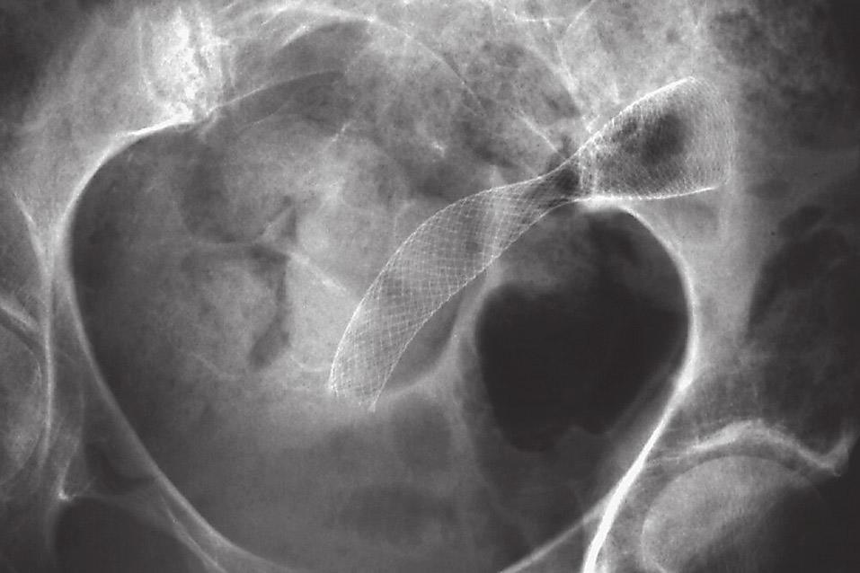 a stenose stenose b Coloninloopfoto s van een 72-jarige patiënt met een obstruerend sigmoïdcarcinoom (a); en buikoverzichtsfoto na plaatsing van een zelfexpanderende metalen stent (b).