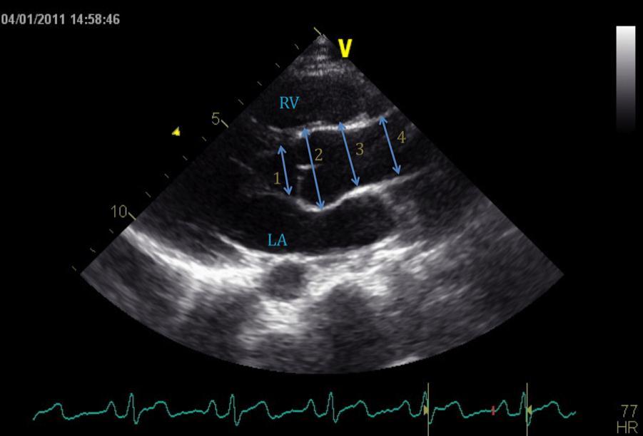 Aortaklep stenose: 3 variabelen werden hiervoor gehanteerd: Gemiddelde gradiënt over de aortaklep, piek gradiënt over de aortaklep en een categorische indeling volgens ernst (afwezig: piek gradiënt