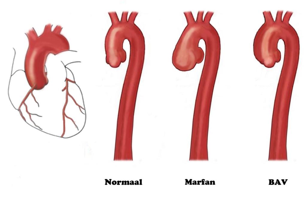 zijn aan het grote tijdsinterval tussen verhoogde bloeddruk en meetbare gevolgen op de aortadiameters.