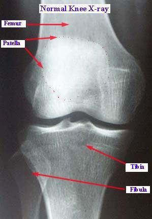 Het normale gewricht: anatomie FEMUR PATELLA