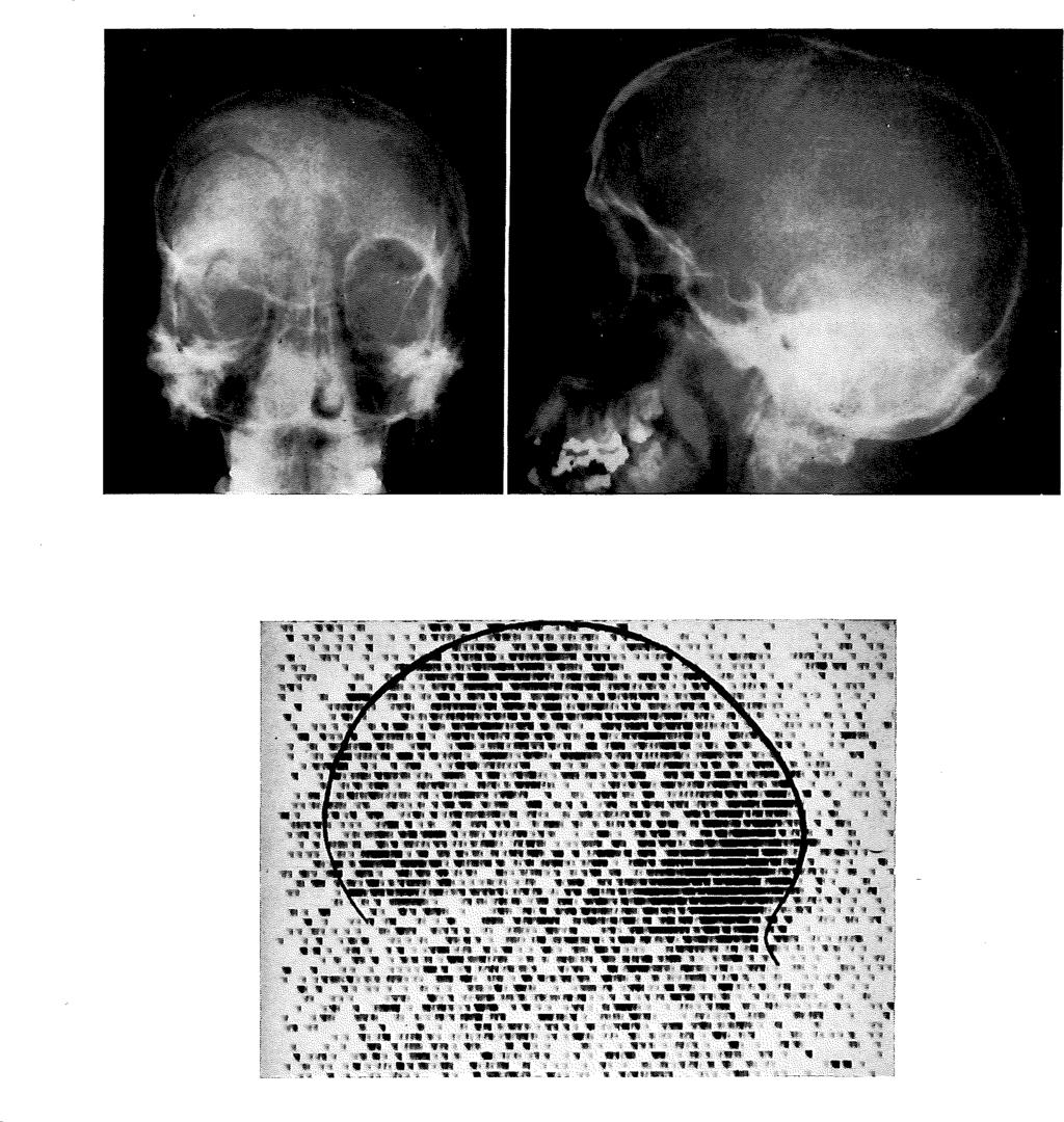 (figuur 26). Hij had meteen na het ongeval een rhinorrhoe gedurende 1 week. Het RIHSA onderzoek liet een verhoogde activiteit zien in het rechter frontale gebied (figuur 27).