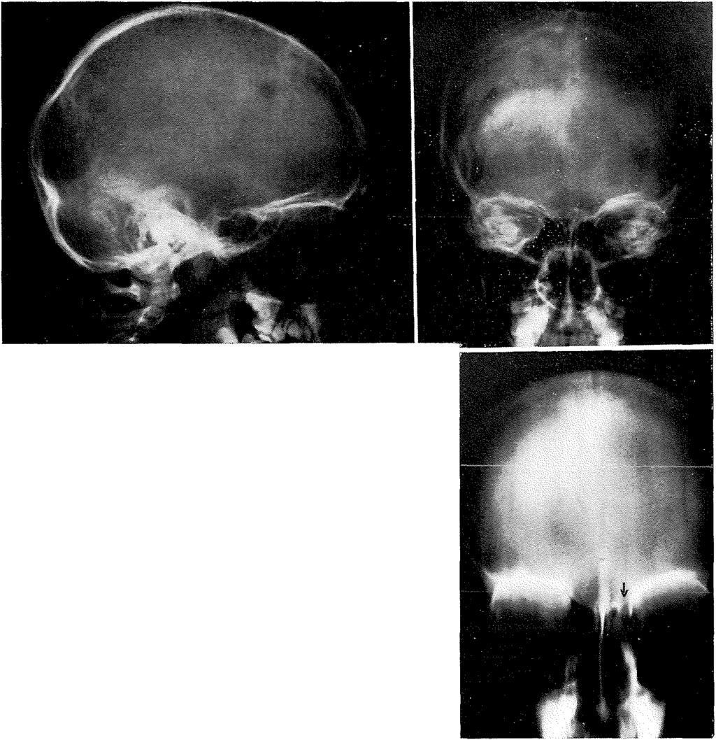 fig. 29. zijdelingse en voorachterwaartse röntgenopnamen van de schedel, waarbij geen defect in de lamina cribrosa aantoonbaar is.