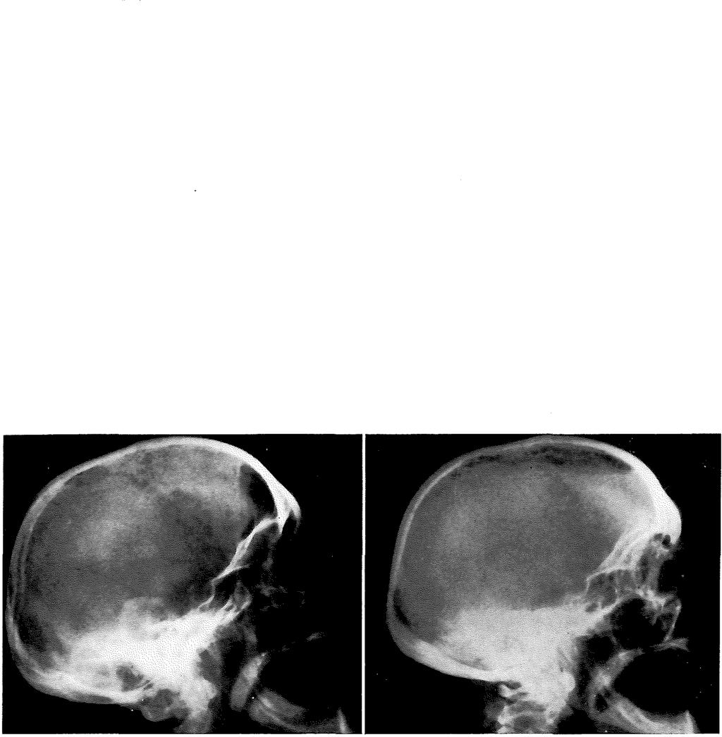 Zowel luchtcisternografie, hersenscintigraphie als angiogram lieten een suprasellaire tumor zien. Er geschiedde een rechtszijdige frontotemporale craniotomie. Hierbij werd de sinus frontalis geopend.