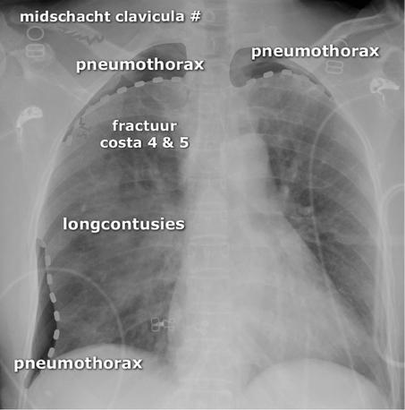 (achterkant) Oplossing 1. Bilaterale pneumothorax. 2.