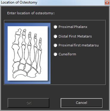 Simulatie voetosteotomie Na het afronden van de deformiteitenmetingen aan de voet kan een simulatie van osteotomieën uitgevoerd worden.