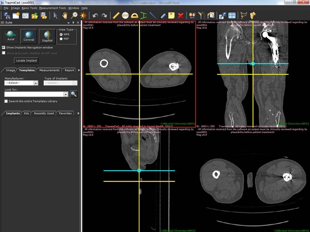 De operatie plannen 3D-SUITE (OPTIONEEL) De 3D-module van TraumaCad maakt het mogelijk afbeeldingen, zoals CT's en MRI's, in drie dimensies te bekijken via meervlaksreconstructie (MPR - Multi-Planar