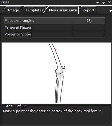 Analyse van uitlijning ledematen De analyse van de uitlijning van de knie stelt orthopedisch chirurgen in staat unilaterale of bilaterale anatomische metingen te nemen, deze te vergelijken met