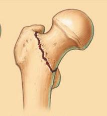 Patiënten die een heupfractuur oplopen hebben vaak nog andere medische problemen zoals osteoporose, gangproblematiek, algemene achteruitgang, Een heupfractuur is een breuk van het uiteinde van het