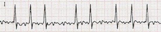#PICTURE plaatje4.jpg 17 Klik op bovenstaande image-knop. Gegeven: Bij een patiënt met een ritmestoornis wordt een ECG opgenomen (zie afbeelding).