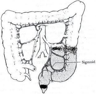 De chirurg verwijdert niet alleen het aangedane deel van de endeldarm. Ook het omliggende vetweefsel waarin de lymfeklieren zitten, wordt verwijderd.