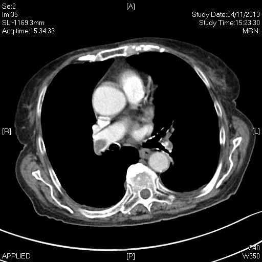 Vrouw, 82 jaar CT thorax: Longembolen in de rechter A. Pulmonalis en de ascenderende en descenderende linker A.