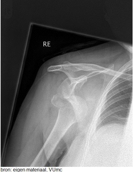 Welke twee afwijkingen zijn op deze Röntgenfoto van de schouder te zien?