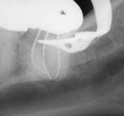 Openen voor herbehandeling De kwaliteit van de endodontie is de laatste jaren op een hoger niveau komen te staan.