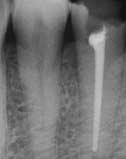 Röntgenologisch is dan ook meestal het beeld van ondervulde wortelkanalen zichtbaar, zoals een te korte kanaalvulling met tevens ruimte tussen de kanaalvulling en de kanaalwand.