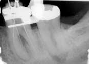 Casus Nauwgezette diagnose voorkomt extractie E en patiënt is op verwijzing binnengekomen met enkele endodontische problemen. Voor deze casus concentreren we ons op het element 36.
