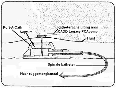 De Port-A-Cath wordt aangeprikt en de CADD-Legacy PCA pomp wordt aangesloten. Vanaf dit moment krijgt u een continue toedoening van pijnstillende medicatie.