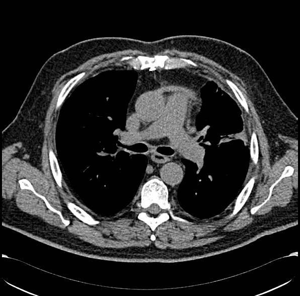 verwezen voor Nivolumab