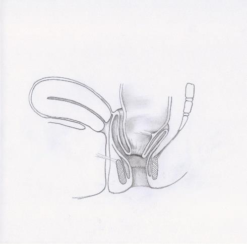 Recto-rectal intussusception (RRI) I (high rectal) Descends no lower than