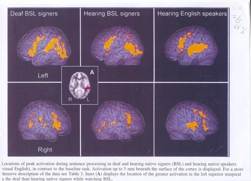na een verkeershersentrauma Doven Luisteren naar gebarentaal Temporale + occipitale cortex Horenden Luisteren naar gebarentaal Occipitale cortex Spreken Luisteren naar