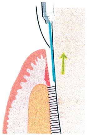 a b c Afb. 1. a. De fiberpunt van de laser wordt in contact gebracht met de gingiva aan de ingang van de pocket.