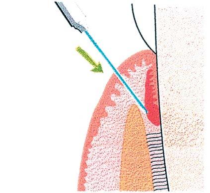 a b Afb. 3. Reverse bevel - incisie wordt gemaakt door de fiber onder een hoek van ongeveer 45º ten opzichte van de tand aan te brengen. Het weefsel wordt met een curette verwijderd.
