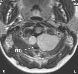 (benigne) MRI Neurinoom: Koh