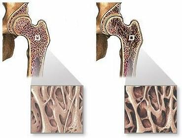 Normaal bot Osteoporotisch bot Hoewel verloren gegaan bot moeilijk kan worden hersteld, kan verder verlies van bot worden voorkomen en het nog overgebleven bot worden